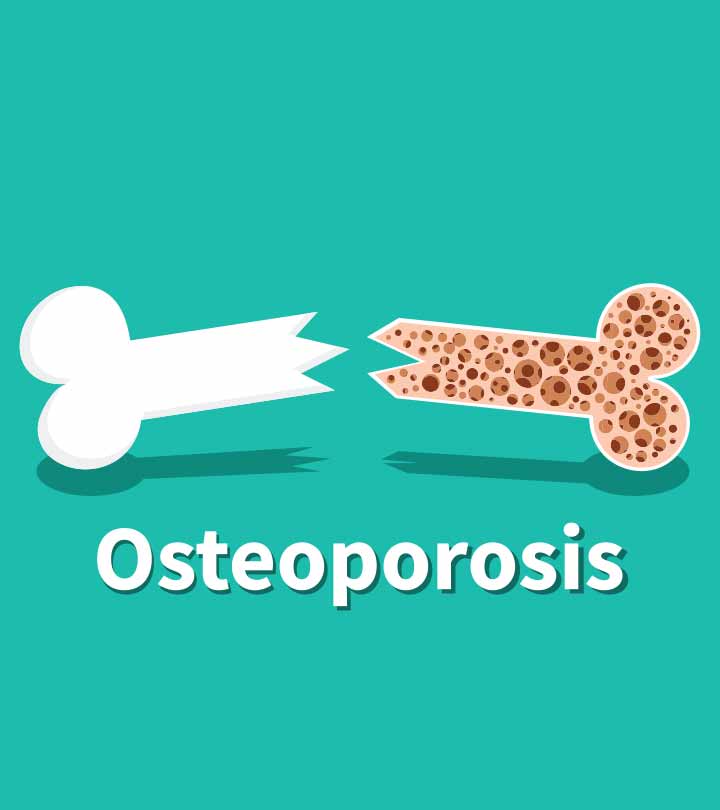ऑस्टियोपोरोसिस के कारण, लक्षण और घरेलू इलाज – Home Remedies for Osteoporosis in Hindi