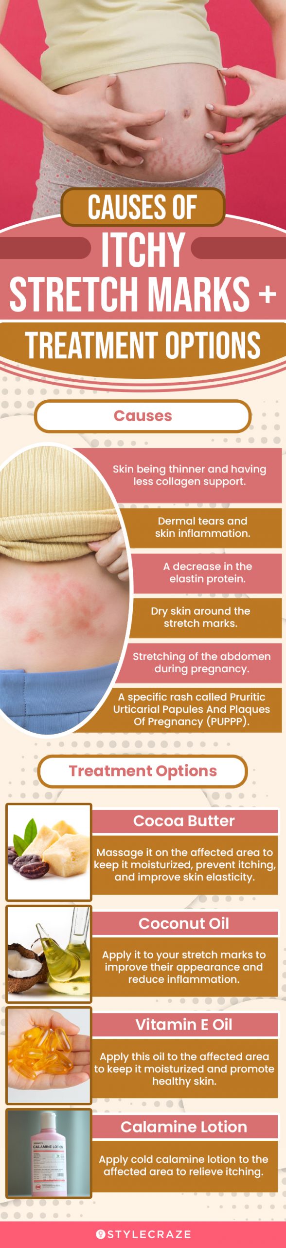 causes of itchy stretch marks and treatment options (infographic)