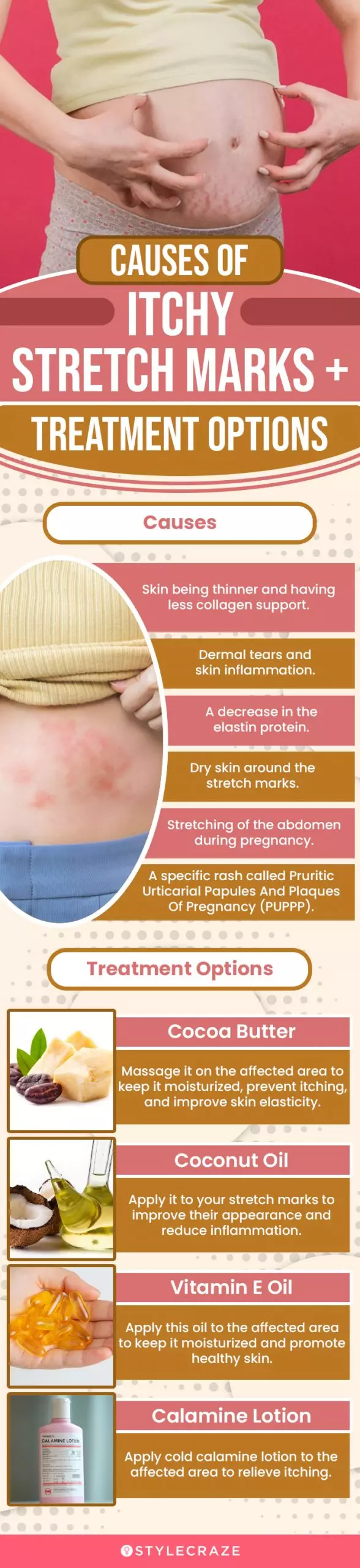 causes of itchy stretch marks and treatment options (infographic)