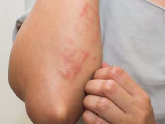 Skin Rashes Causes Symptoms