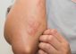 त्वचा पर चकत्ते के कारण, लक्षण और घरेलू उपाय - Skin Rashes Causes ...