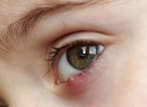 आंख में गुहेरी के कारण, लक्षण और घरेलू उपाय - Stye Causes ...