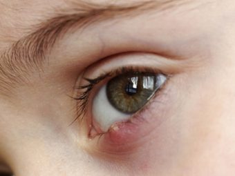 Stye Causes, Symptoms and Home Remedies