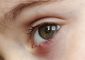 Stye Causes, Symptoms and Home Remedies