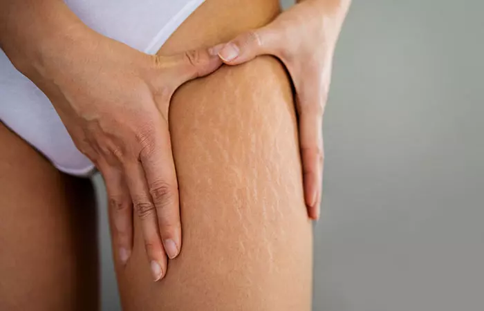 Close-up of stretch marks on a woman's thigh.