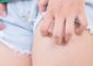Itchy Stretch Marks: Causes, Treatmen...