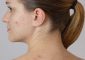 Back Acne Causes, Symptoms and Home Remedies in Hindi