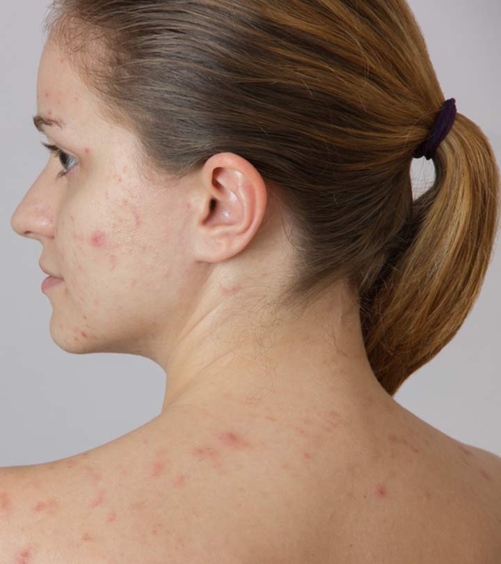 पीठ के मुंहासे के कारण, लक्षण और घरेलू उपाय - Back Acne Causes ...