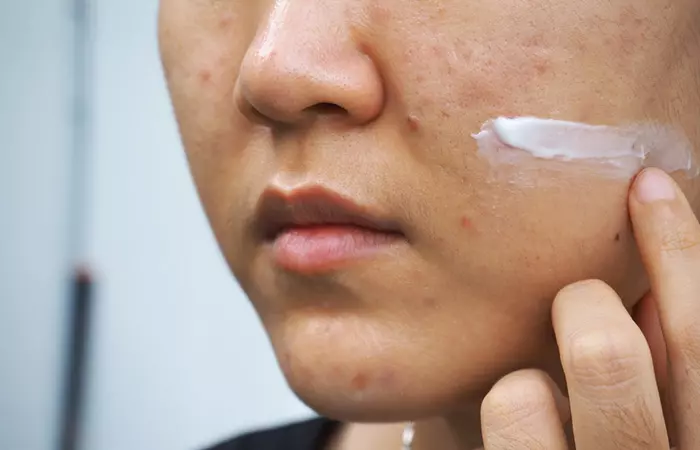 Stop Using Harsh Chemicals On Your Face