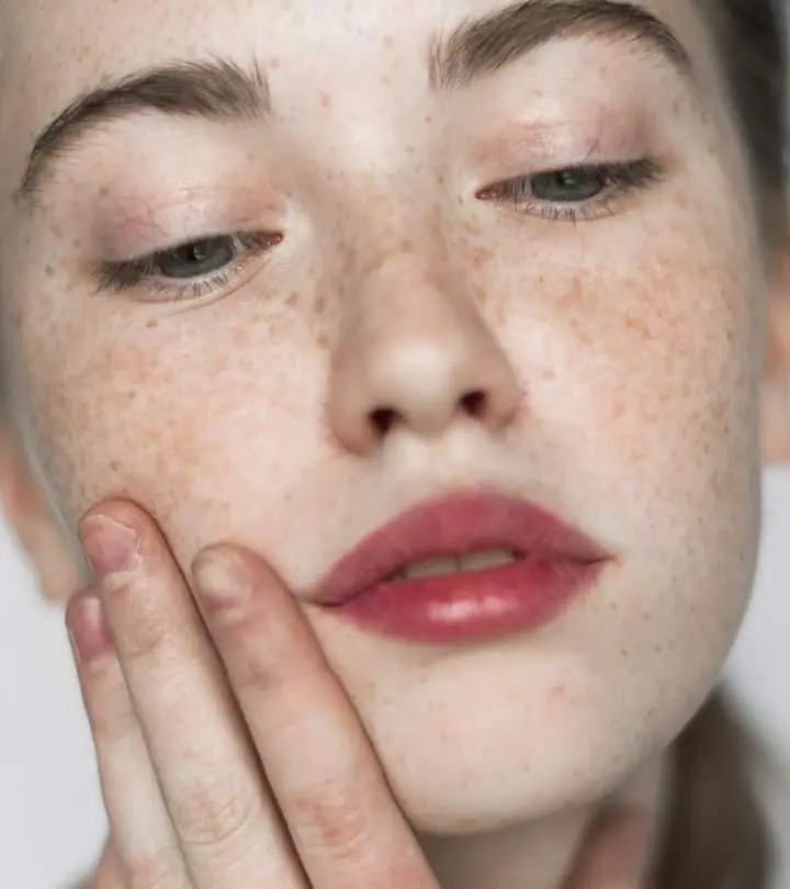 Treat Hyperpigmentation And Tips To Prevent It