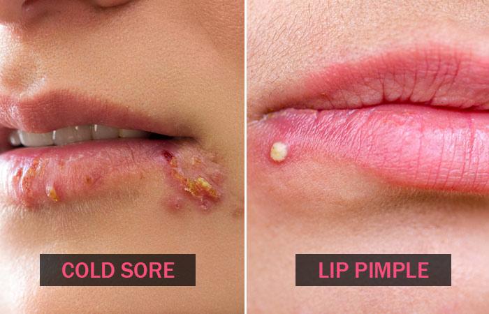 Cold Sores Vs. Pimples: How They Look, Causes, & Treatment