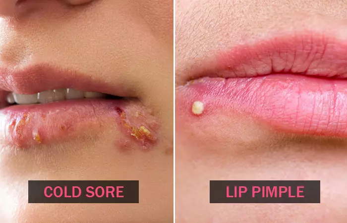 What do cold sores and lip pimples look like