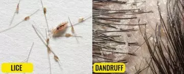Lice and dandruff comparison