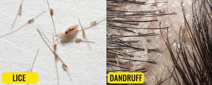 head lice eggs vs dandruff
