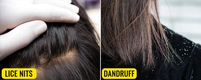 difference between lice eggs and dandruff