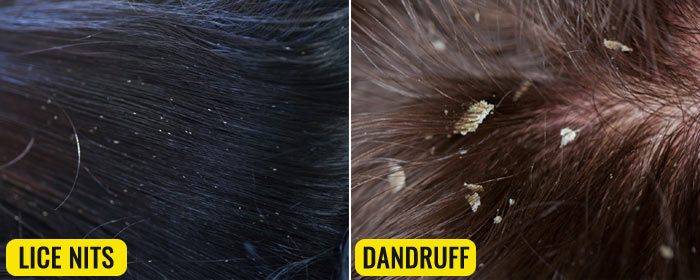 difference between lice eggs and dandruff