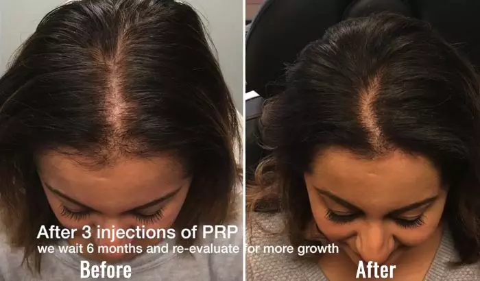 PRP results after 3 injections before and after treatment