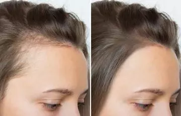 Before and after using emu oil for hair loss 4
