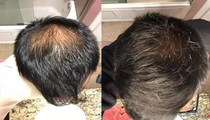 Finasteride hair growth results picture 2