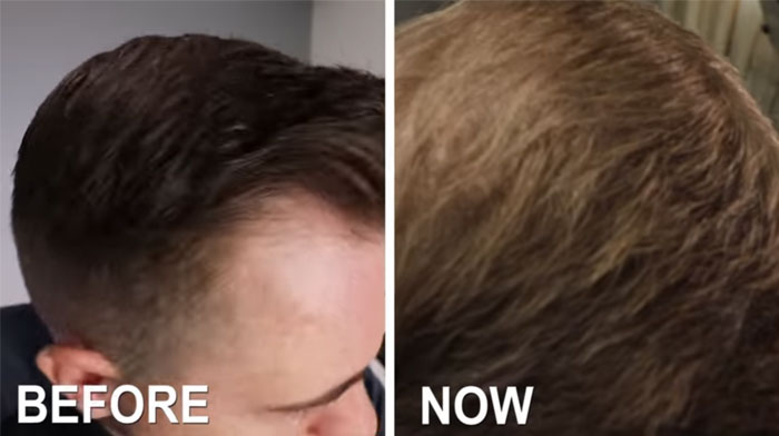 Finasteride hair growth results picture 1