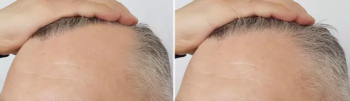 Finasteride hair growth results