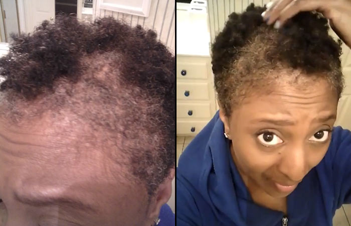 Laser treatment for hair growth before and after picture 2