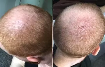 Laser treatment for hair growth before and after picture 3