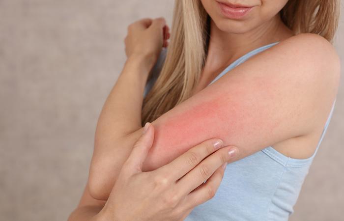 Woman with arm rash due to side effect of mineral oil
