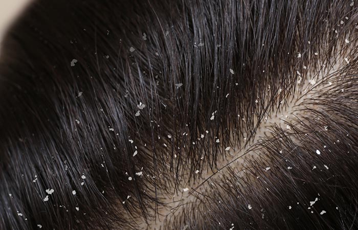 Washing your hair with cold water may help reduce dandruff