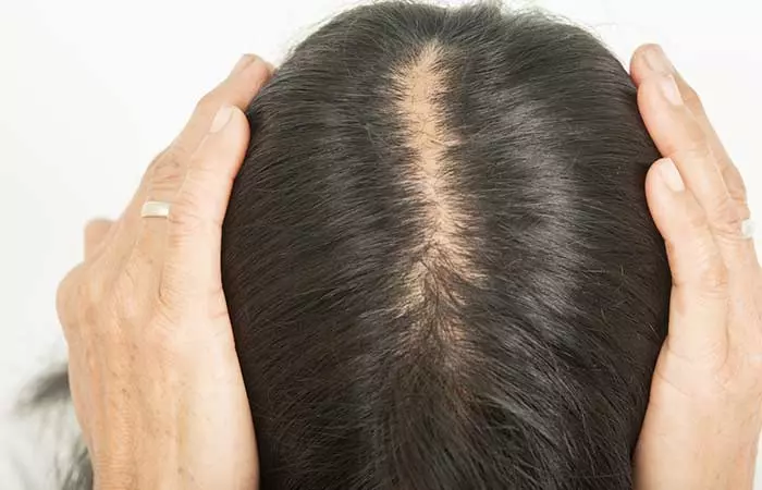 Thinning hair from the crown in androgenic alopecia