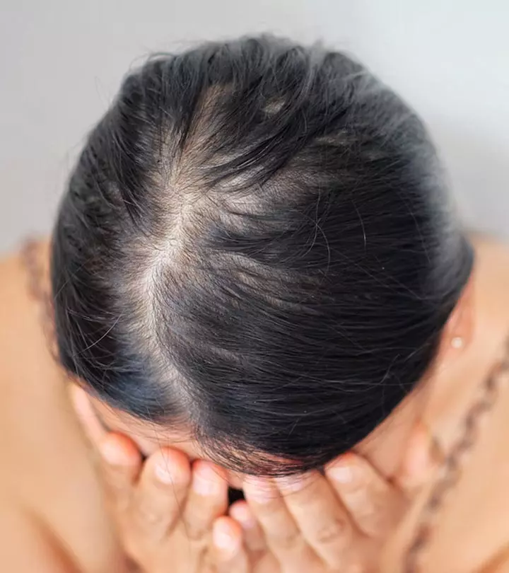 Diffuse Alopecia Causes, Symptoms, And Treatment
