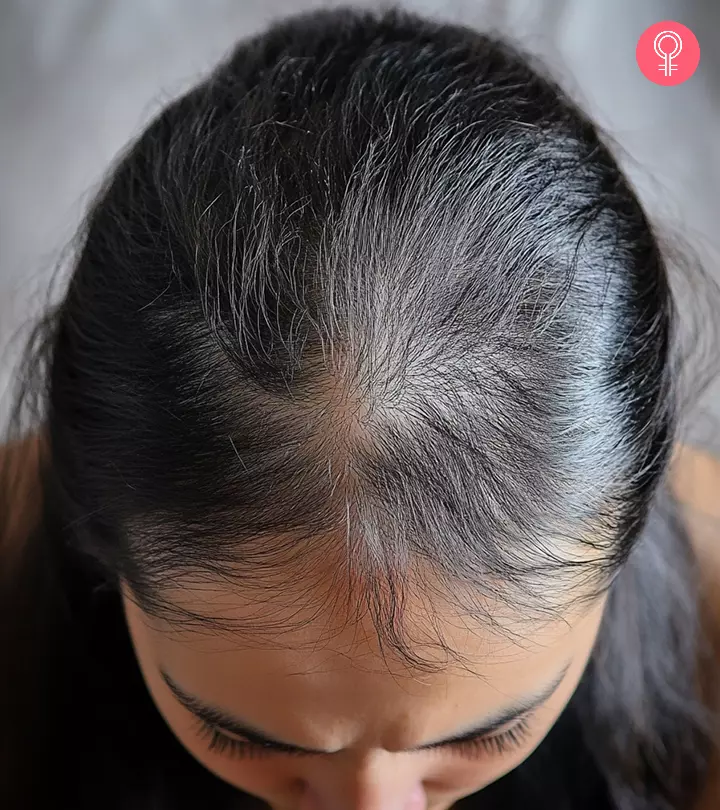 Women Suffering From Diffuse Alopecia