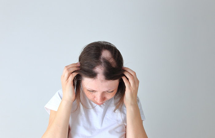 Drug-induced alopecia may lead to hair loss on legs
