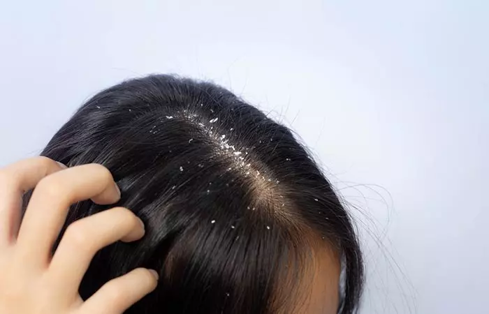 Fenugreek seeds may treat dandruff and improve scalp health
