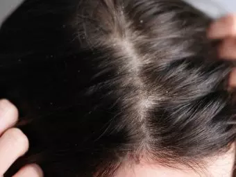 Scalp Buildup: Causes, Treatment, And Prevention