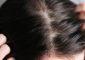 Scalp Buildup: Causes, Treatment, And...