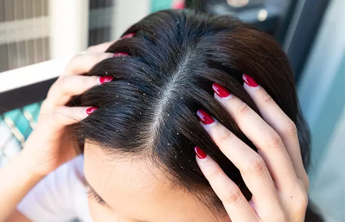 Woman experiencing dandruff and itchy scalp which can be addressed with high-frequency hair treatment