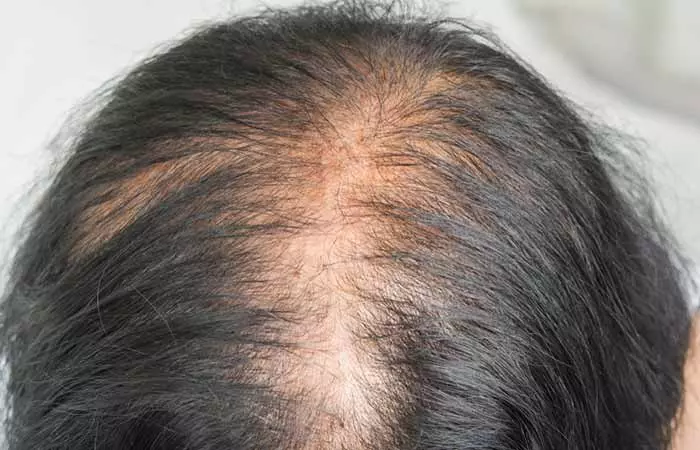 Scalp hair loss in androgenic alopecia