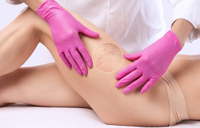 Subir Auroch Para editar Side Effects Of Laser Hair Removal You Should Know About