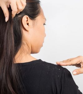 The Truth About Anti-Dandruff Hair Oils