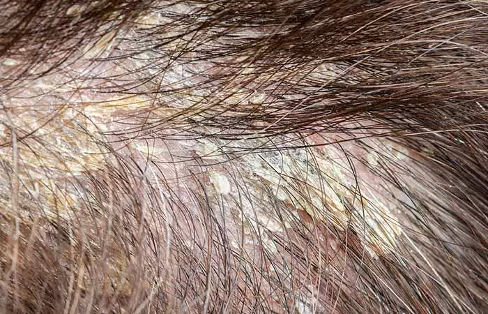 What does scalp buildup look like