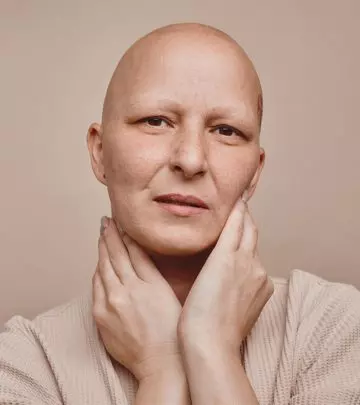 All You Need to Know About Alopecia Totalis