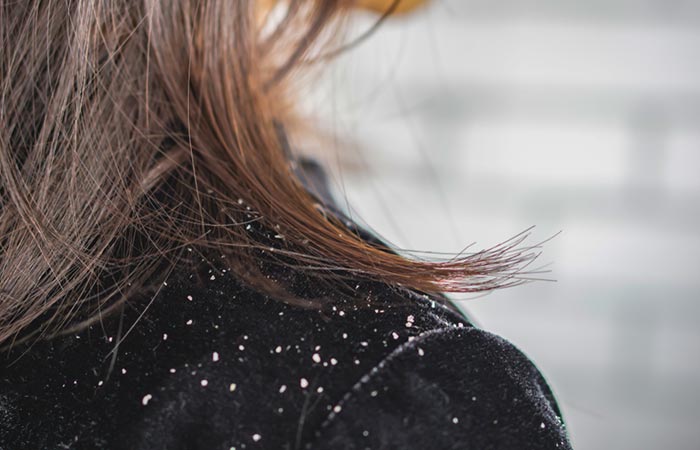 Woman with excessive dandruff 