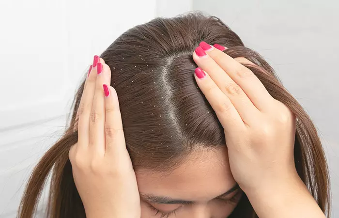 Woman with dandruff in her hair