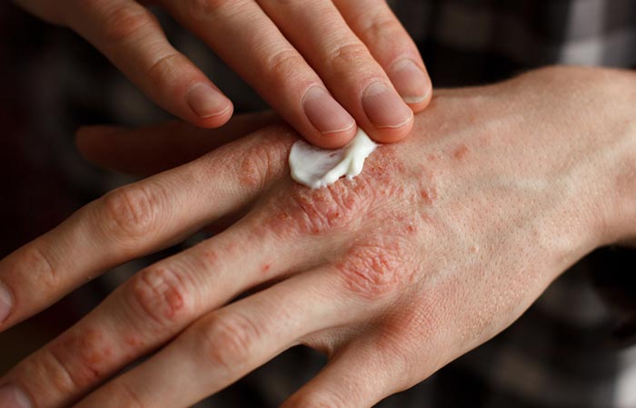 Woman applying cream on dry, flaky skin