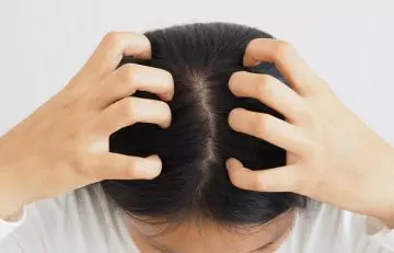 Woman experiencing an itchy scalp after using rubbing alcohol