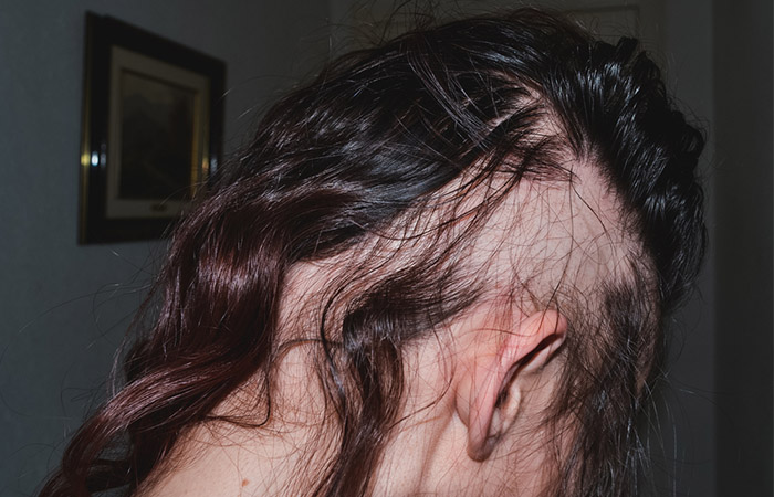 Woman with balding and thinning hair
