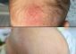 Cradle Cap Vs. Dry Scalp – What Is The Difference?