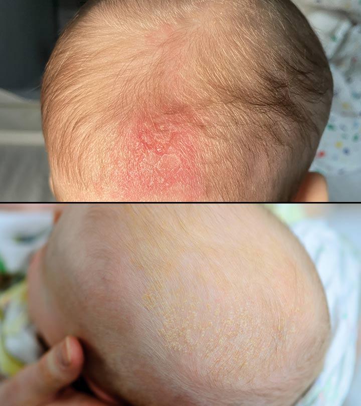 Cradle Cap vs.  Couro cabeludo seco - qual é a diferença?