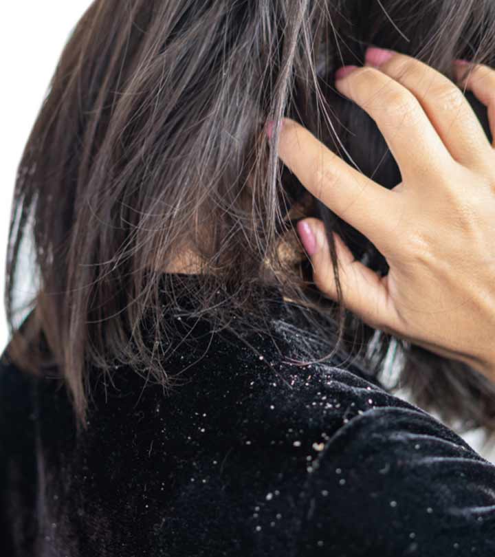 4 Home Remedies For Dandruff | Causes And Symptoms